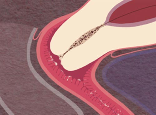 Zoom sur le col de l’utérus et les sécrétions vaginales extrait de la planche cycle menstruel, formats imprimés et numériques