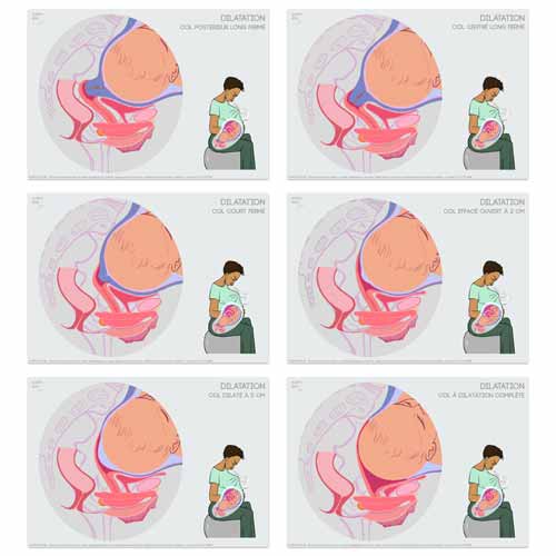 Fiches numériques de la dilatation du col sans légendes, à compléter ou utiliser en support d’animation