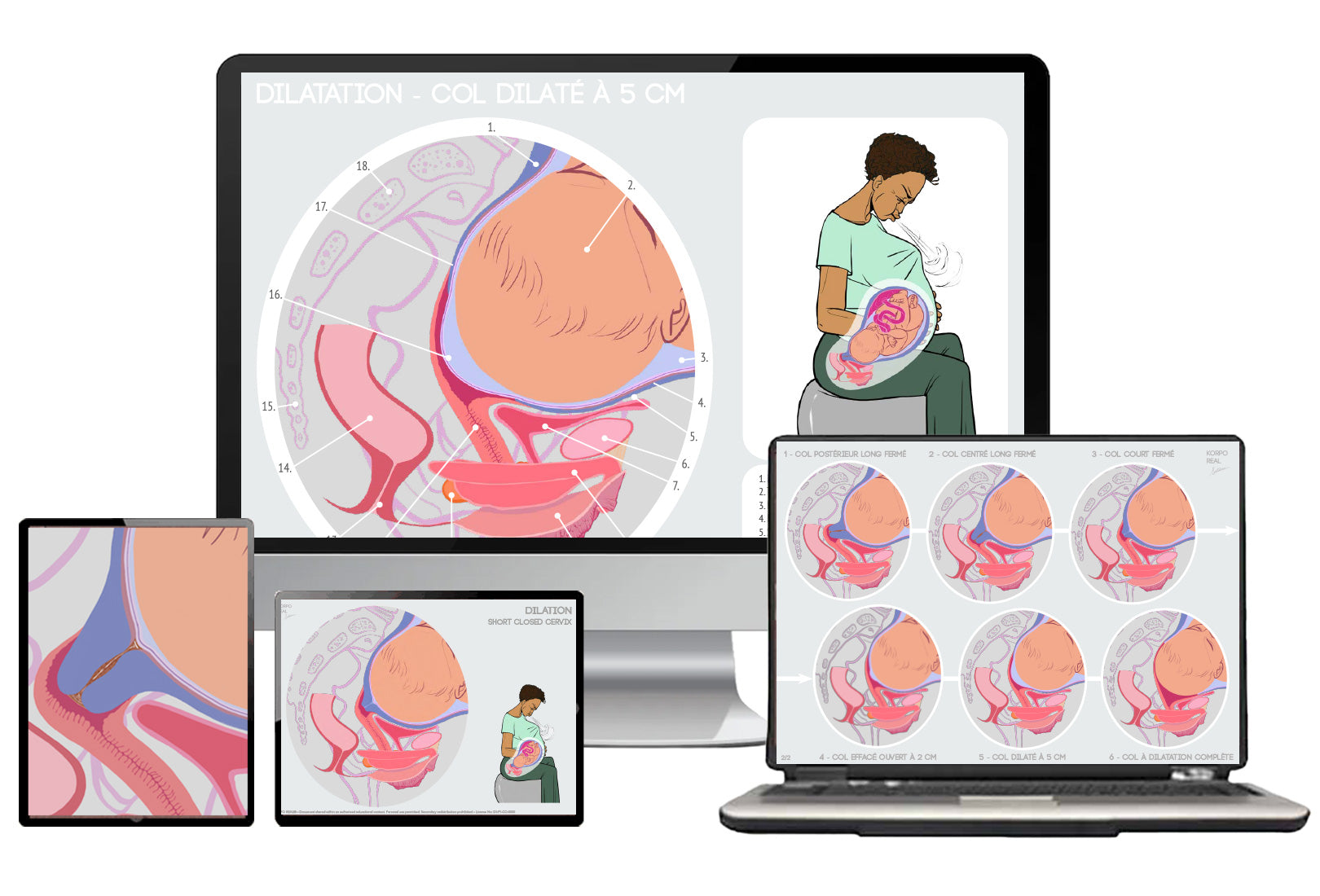 Présentation numérique de la planche anatomique de la dilatation du col affichée sur différents écrans d’ordinateur