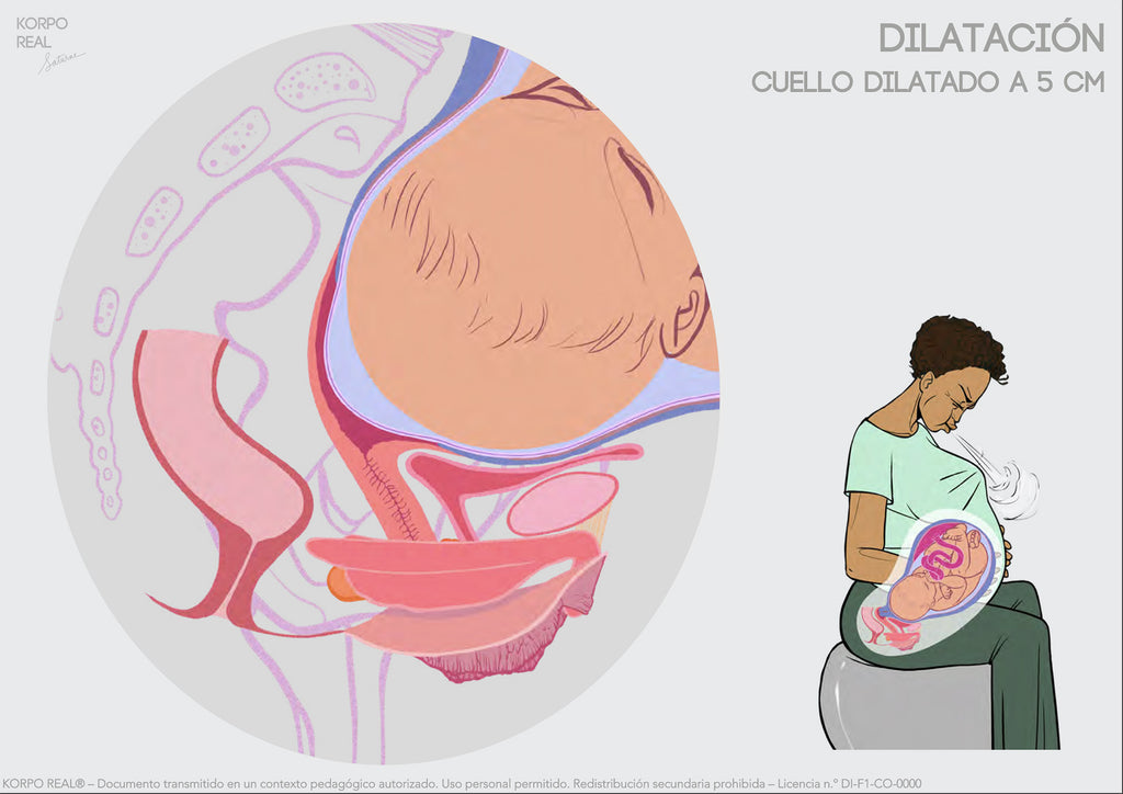 Illustration anatomique d’une étape de la dilatation du col de l’utérus sans légende, avec personnage